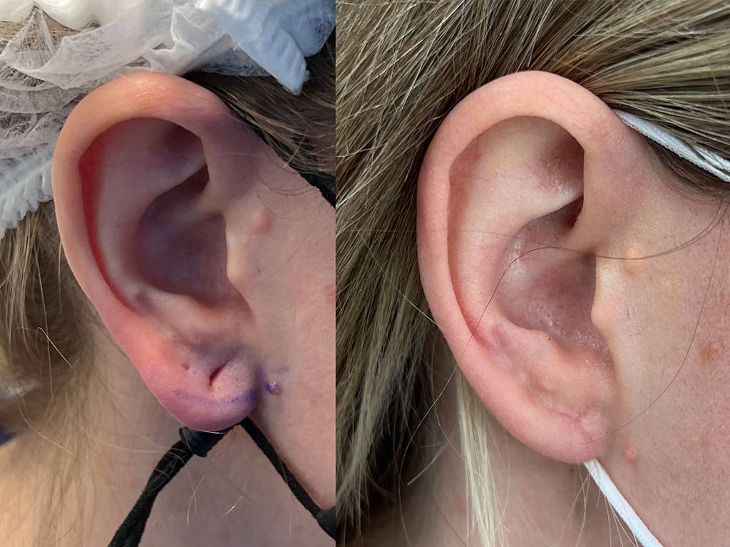 Earlobe Reduction Before/ After