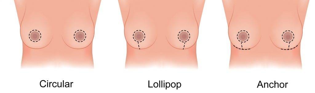 Diagrams Of Different Breast Reduction Surgeries: Circular, Lollipop, And Anchor