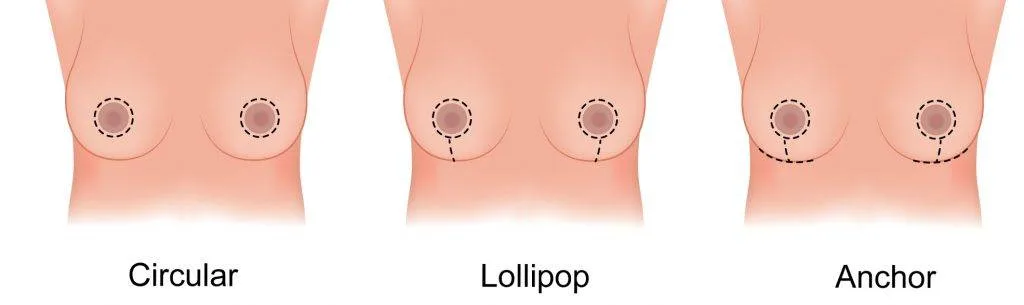 Diagrams Of Different Breast Reduction Surgeries: Circular, Lollipop, And Anchor