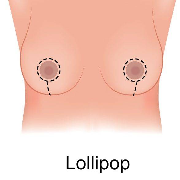 Surgical incisions for reduction mammoplasty. (a) An incision is