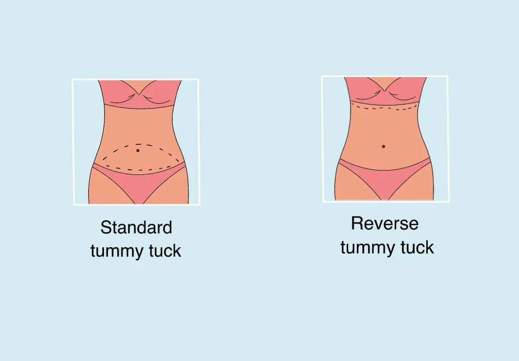 Reverse Tummy Tuck Vs. Tummy Tuck