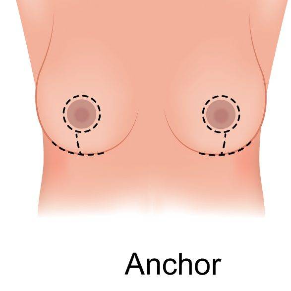 breast reduction incisions