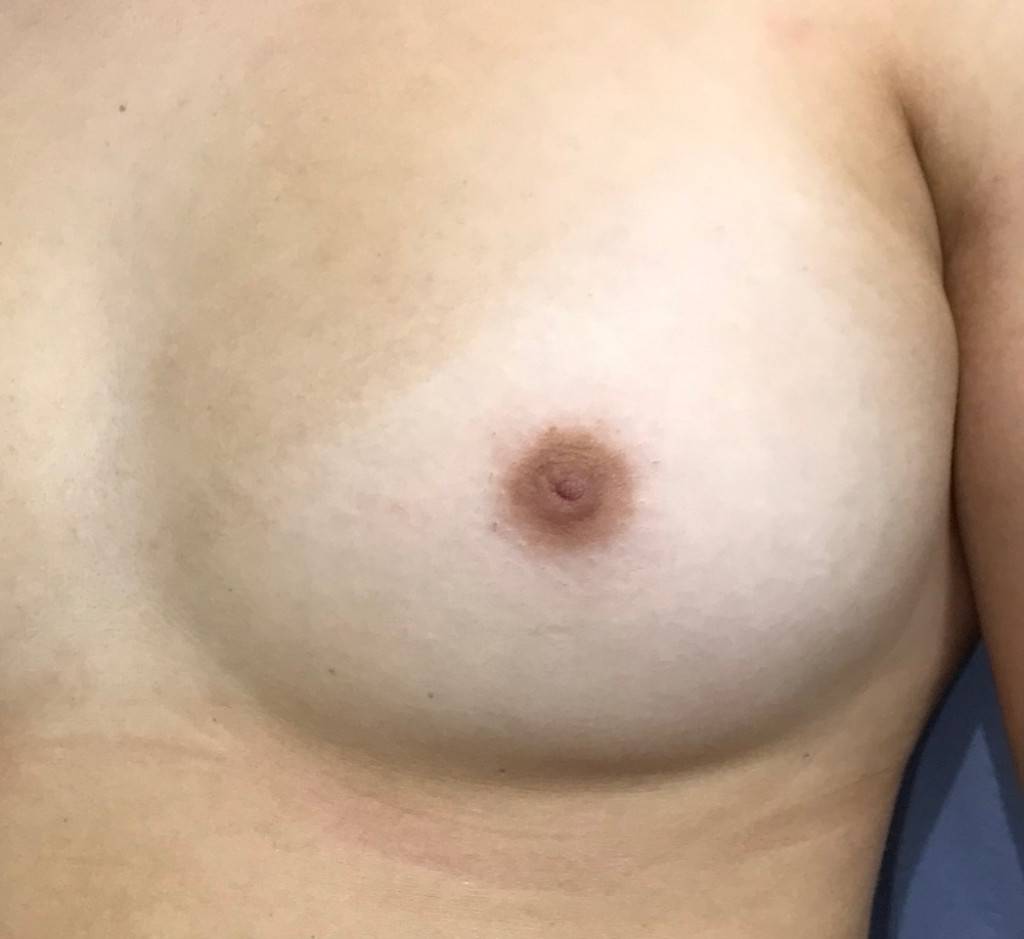 Grade 2 Inverted Nipple