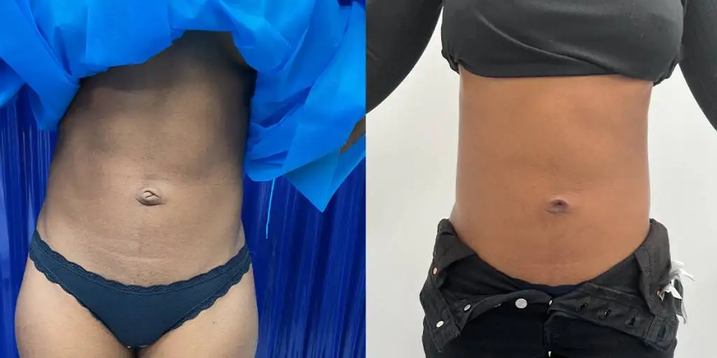 01.23 Umbilicoplasty Front