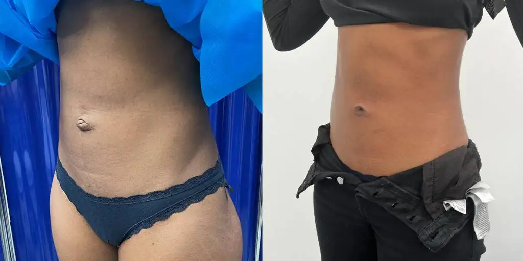 01.23 Umbilicoplasty Quarter