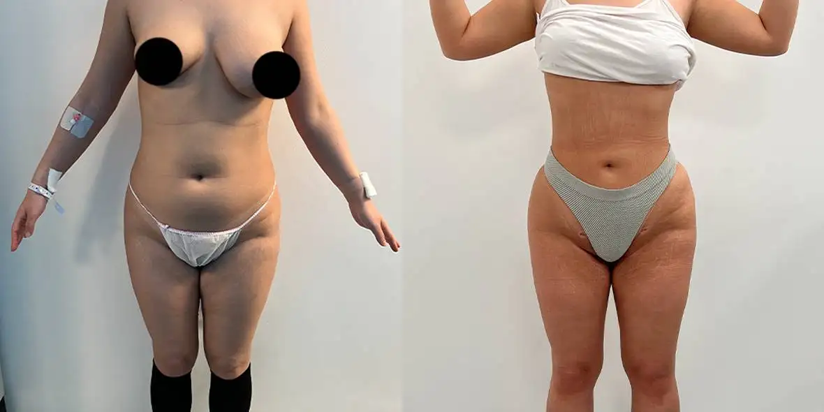 Brazilian Butt Lift Before And After