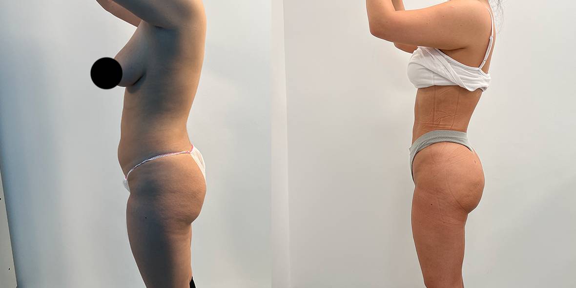 Esthé Clinic London - 💫What is a non-surgical Brazilian Butt Lift?  Patients can now achieve the same lifting and volumizing benefits of a  Brazilian butt lift without going anywhere near a scalpel.