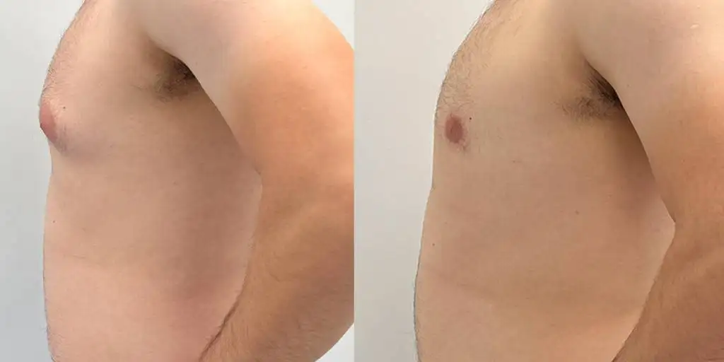 03.23 Gynecomastia Left