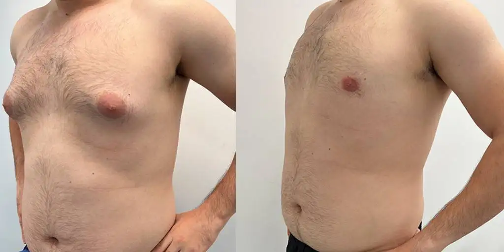 03.23 Gynecomastia Quart 1
