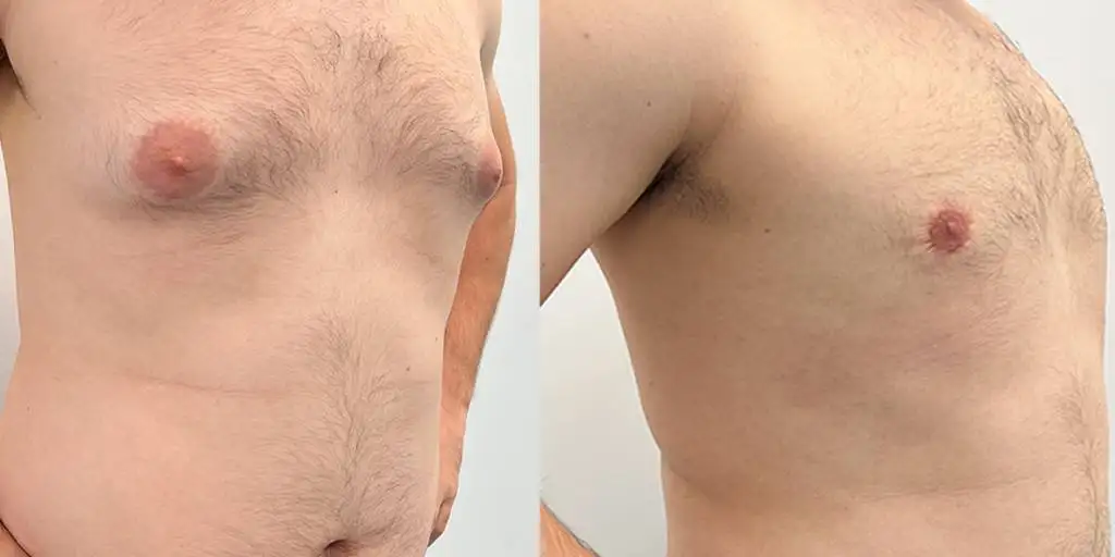 03.23 Gynecomastia Quart 2