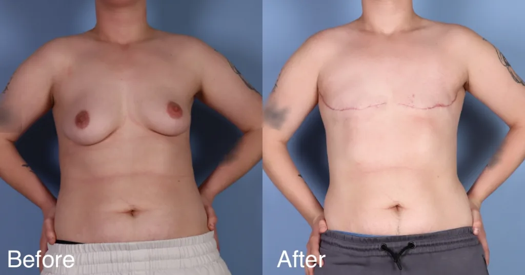Patient Before And After Ftm Top Surgery