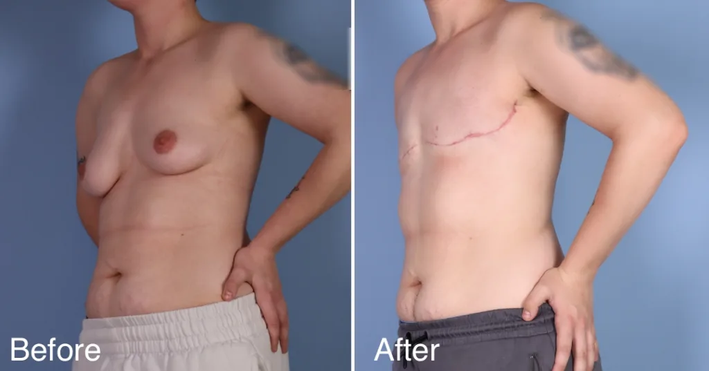 Patient Before And After Ftm Top Surgery