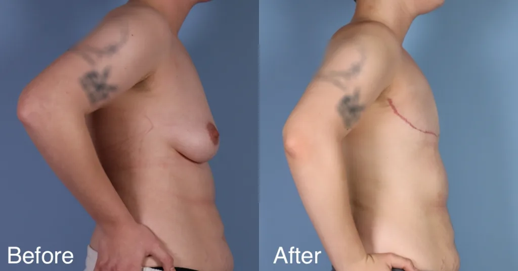 Patient Before And After Ftm Top Surgery