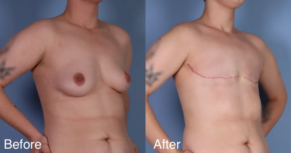 Patient Before And After Ftm Top Surgery