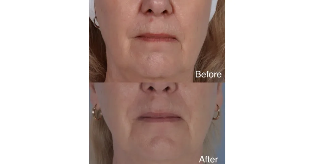 Patient Before And After 2 Sessions Of Fotona 4D