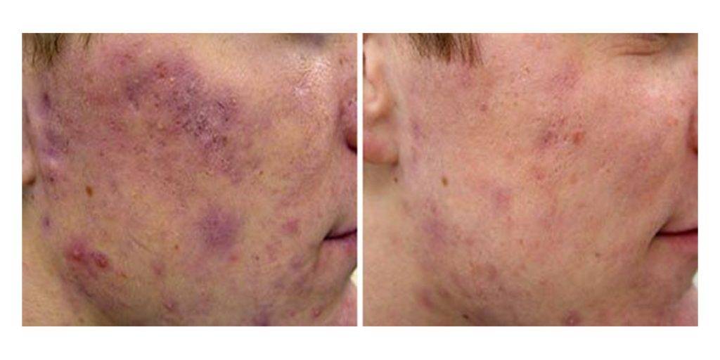 Laser Acne Removal Before and After 1