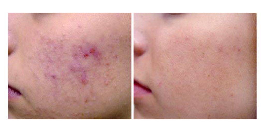 Laser Acne Removal Before and After 2