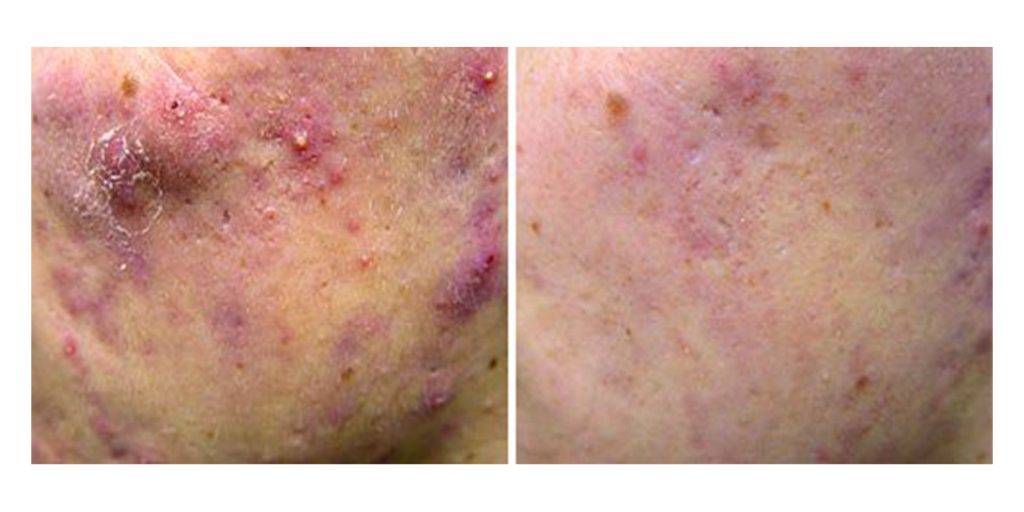 Laser Acne Removal Before and After 3