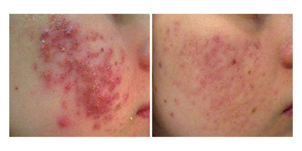 Laser Acne Removal Before and After 4