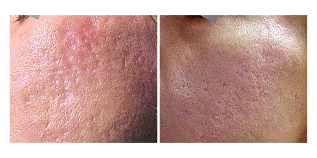 Laser Acne Scar Removal Before And After 1
