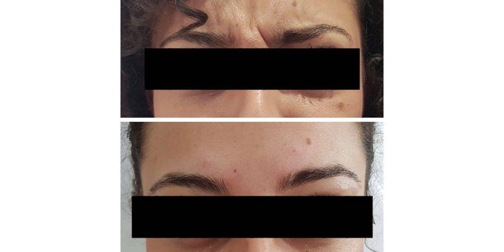 Anti ageing injections before and after