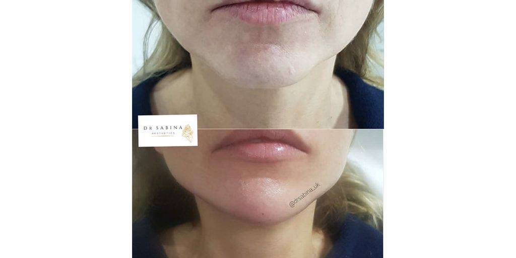 Chin Filler before and after 1