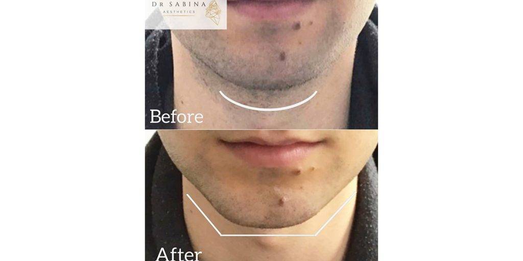Chin Filler before and after 2