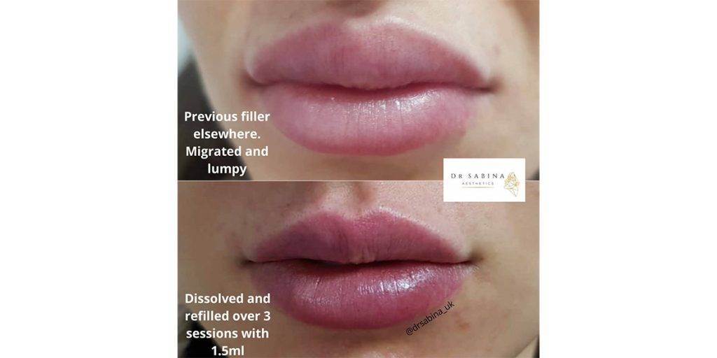 lip filler before and after 2