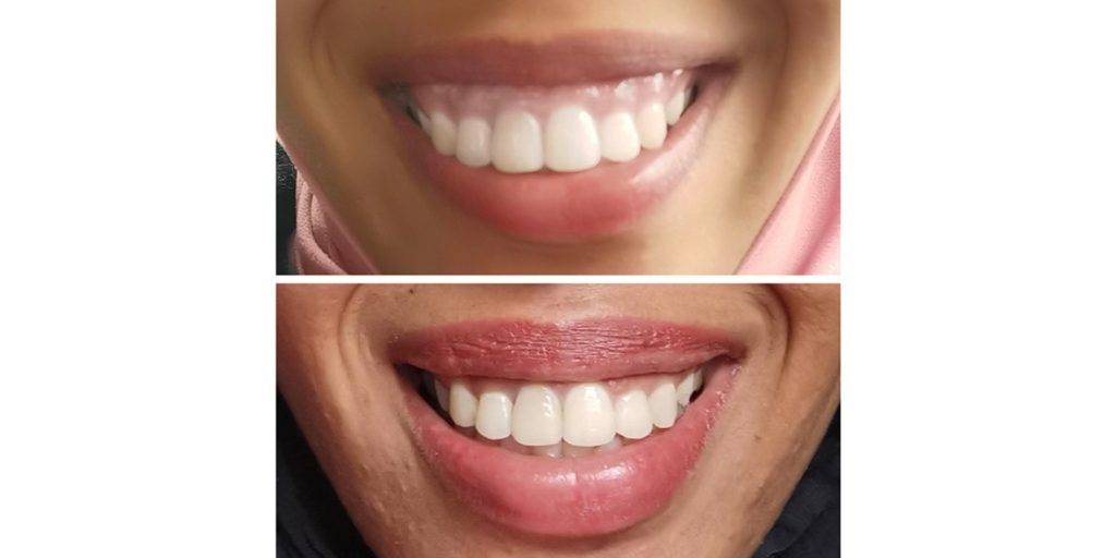Gummy Smile before and after 2