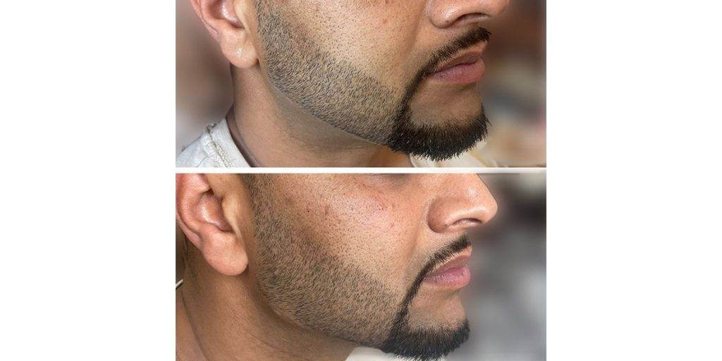 jawline filler before and after