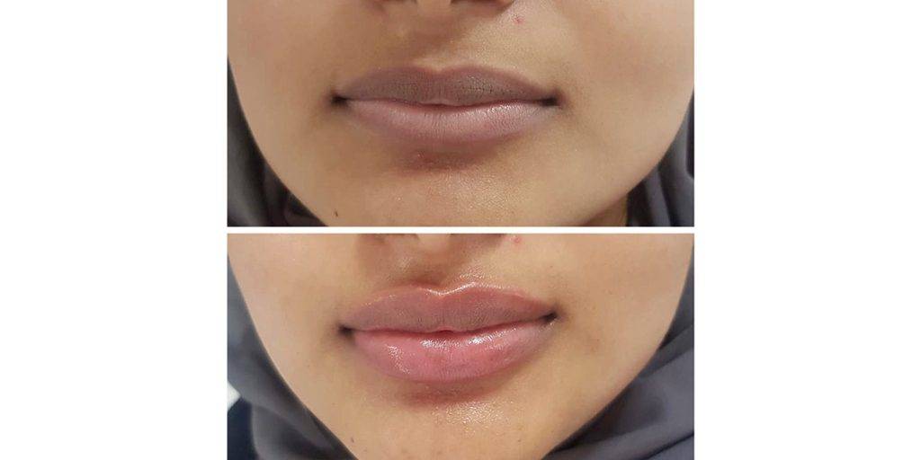 lip filler before and after 14