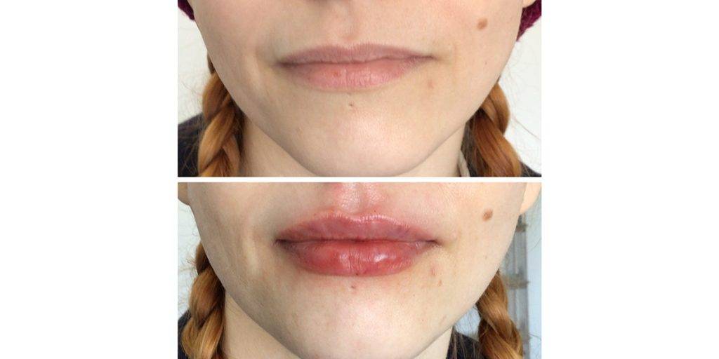 lip filler before and after 16