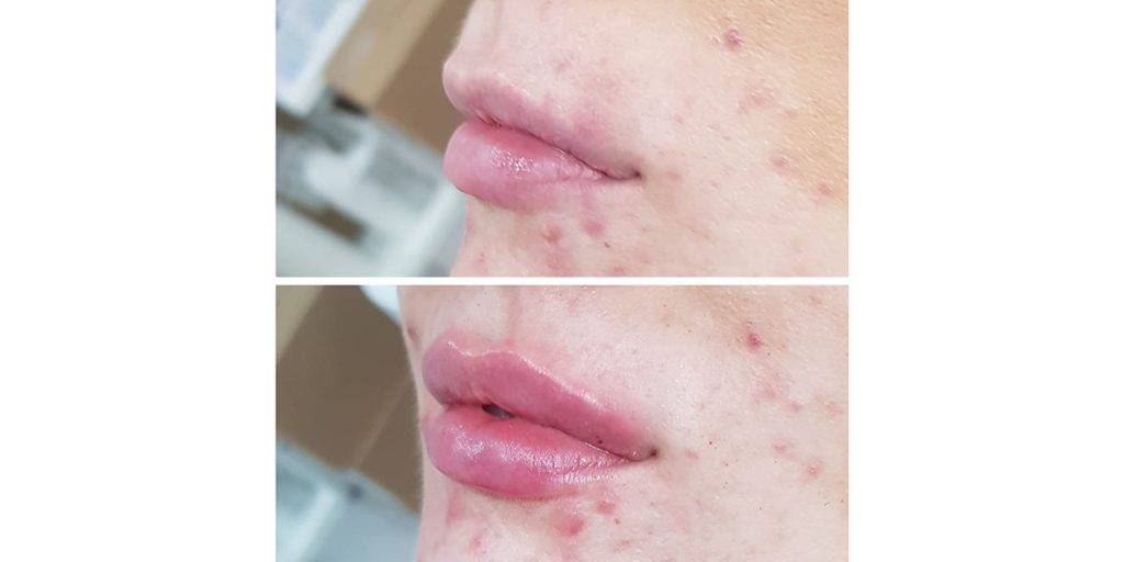 lip filler before and after 17