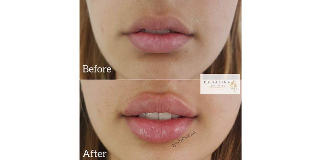 lip filler before and after 18