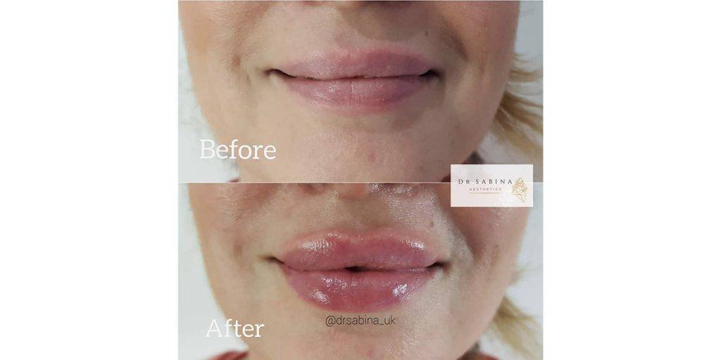 lip filler before and after 19