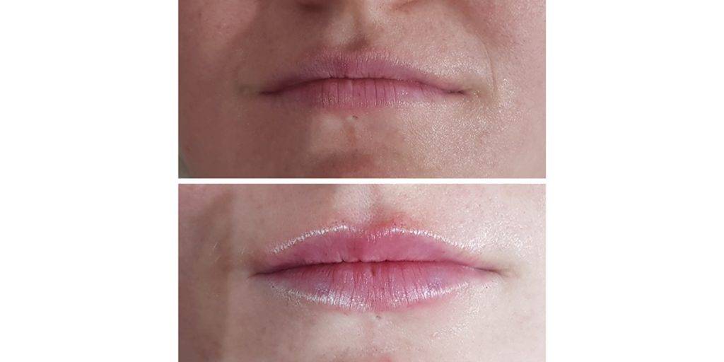 lip filler before and after 20