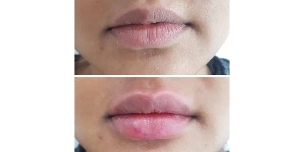 lip filler before and after 21