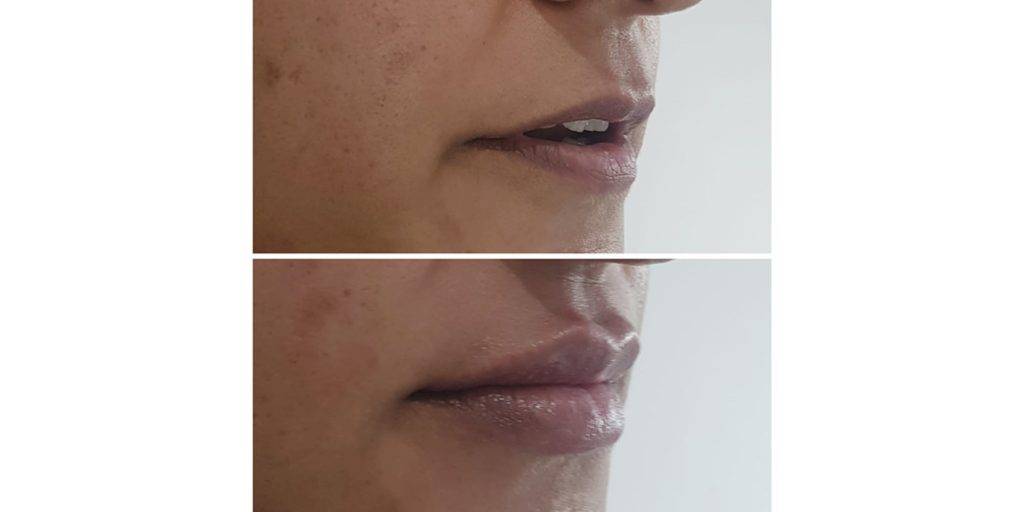 lip filler before and after 5