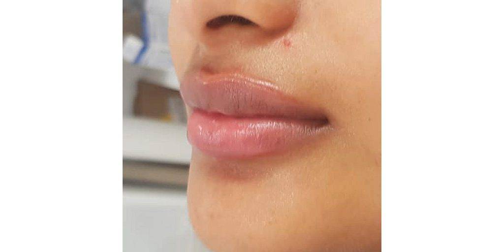 lip filler before and after 24