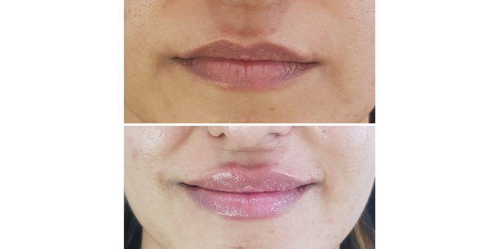 lip filler before and after 6