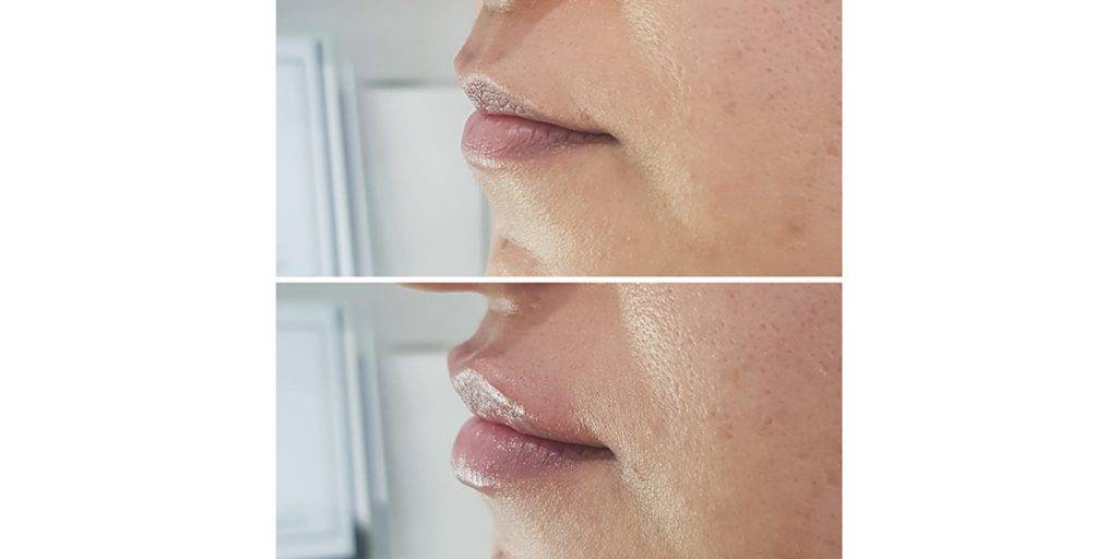 lip filler before and after 24