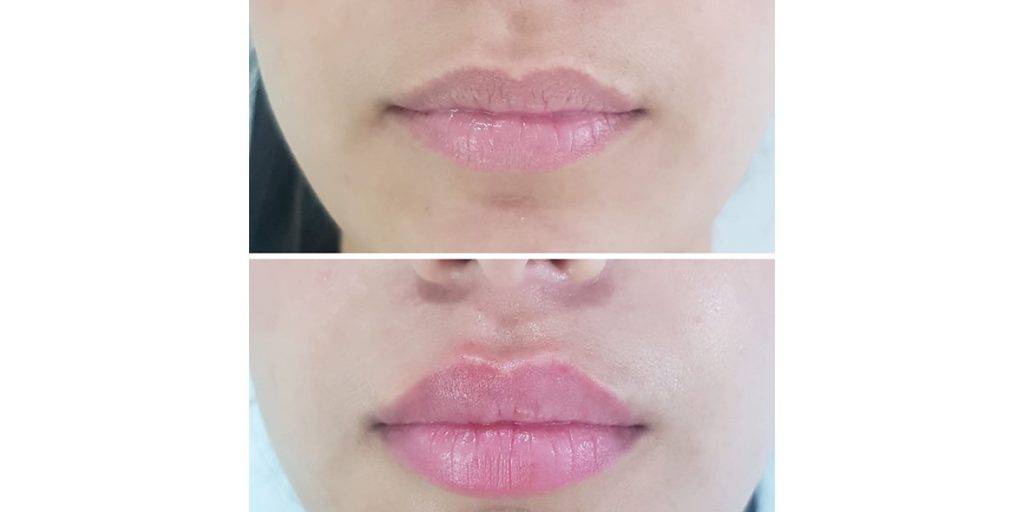 lip filler before and after 8