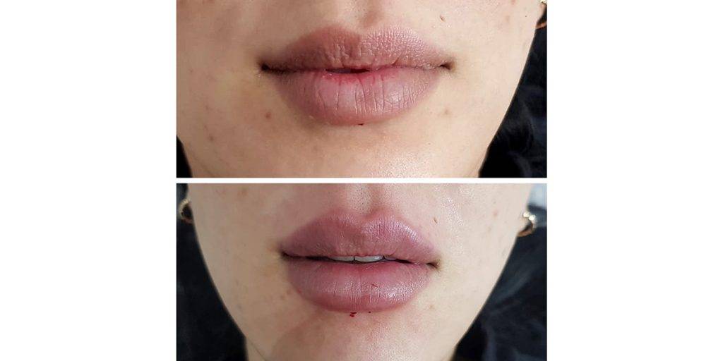 lip filler before and after 9