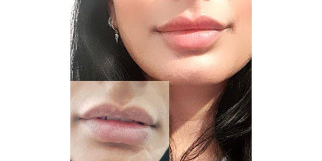 lip filler before and after 11