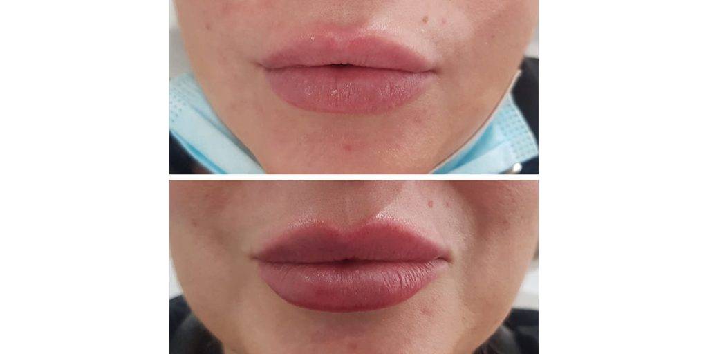 lip filler before and after 12