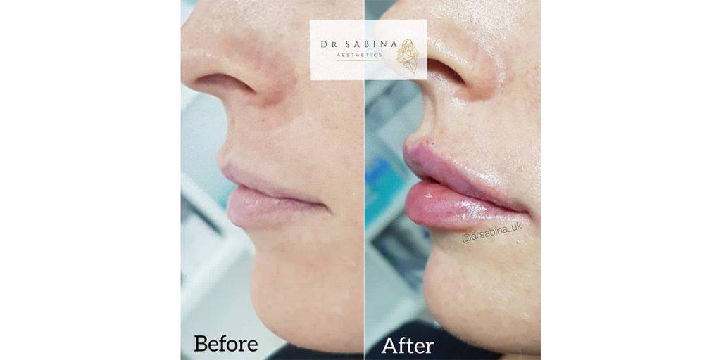 lip filler before and after 3