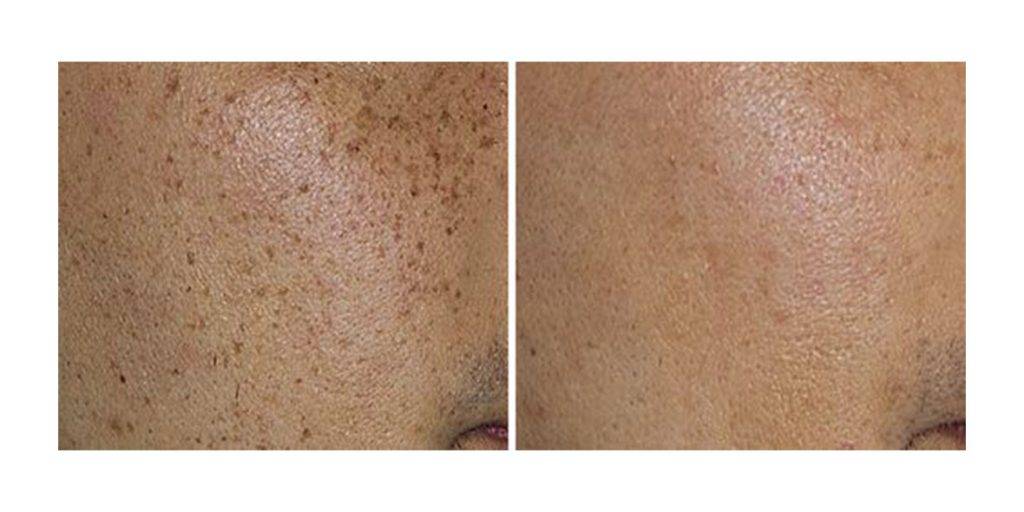 Pigmented Lesion Laser Treatment Before and After 1