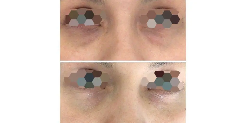 Plenhyage Before And After 1