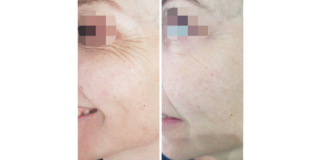 Skin boosters before and after 2