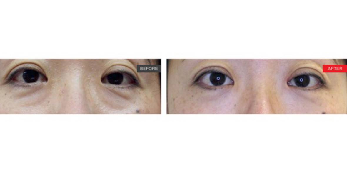 Laser Eyelid Tightening